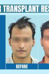 Why India Is the Best Place to Go for Hair Transplant Tourism in 2025