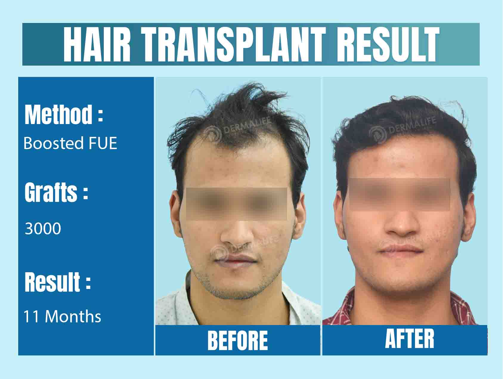 Why India Is the Best Place to Go for Hair Transplant Tourism in 2025